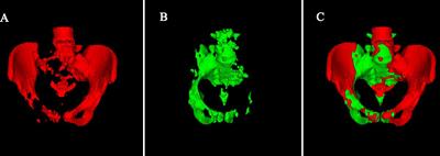 Role of 18FDG PET/CT metabolic parameters in predicting hematological toxicity during chemoradiotherapy for locally advanced cervical cancer